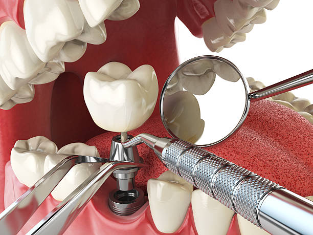 Urgent Tooth Repair in TX